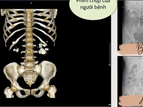 Xem phim chụp CT, bác sĩ “tá hỏa” khi thấy điều không ai ngờ trong thận người bệnh