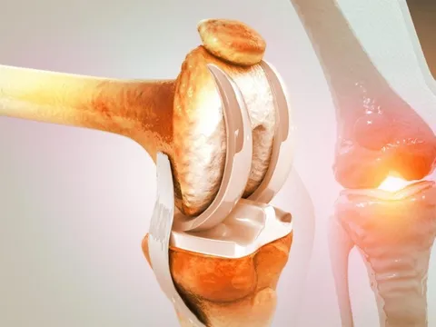 4 loại thực phẩm "ăn mòn" khớp nhanh nhất nếu lạm dụng: Toàn món khoái khẩu của nhiều người